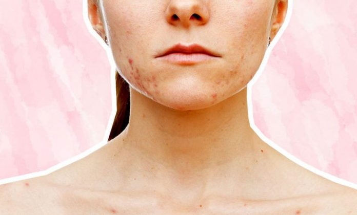 acne scar treatment in Toronto